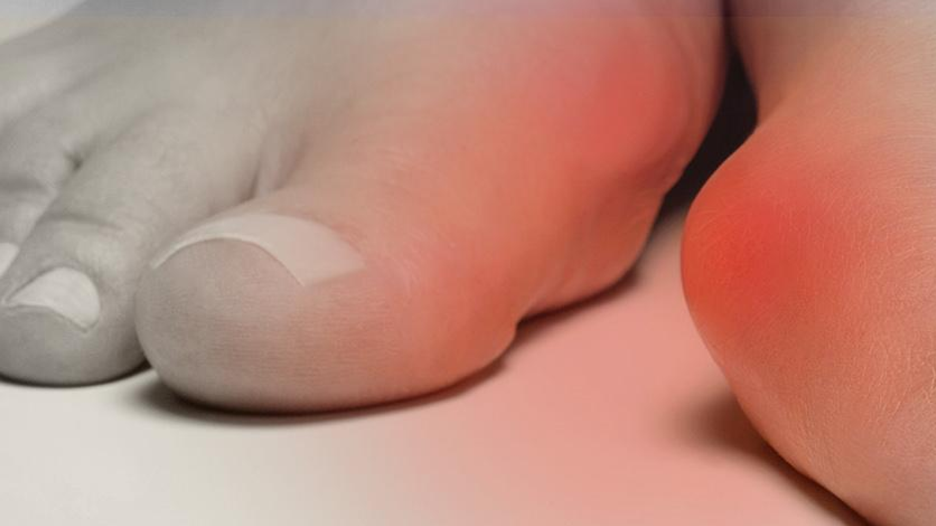 Hallux Valgus